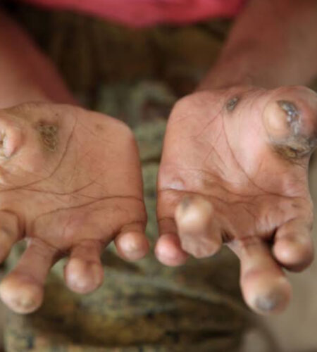 Dalili za Ugonjwa wa Ukoma, Sababu na Tiba Zake